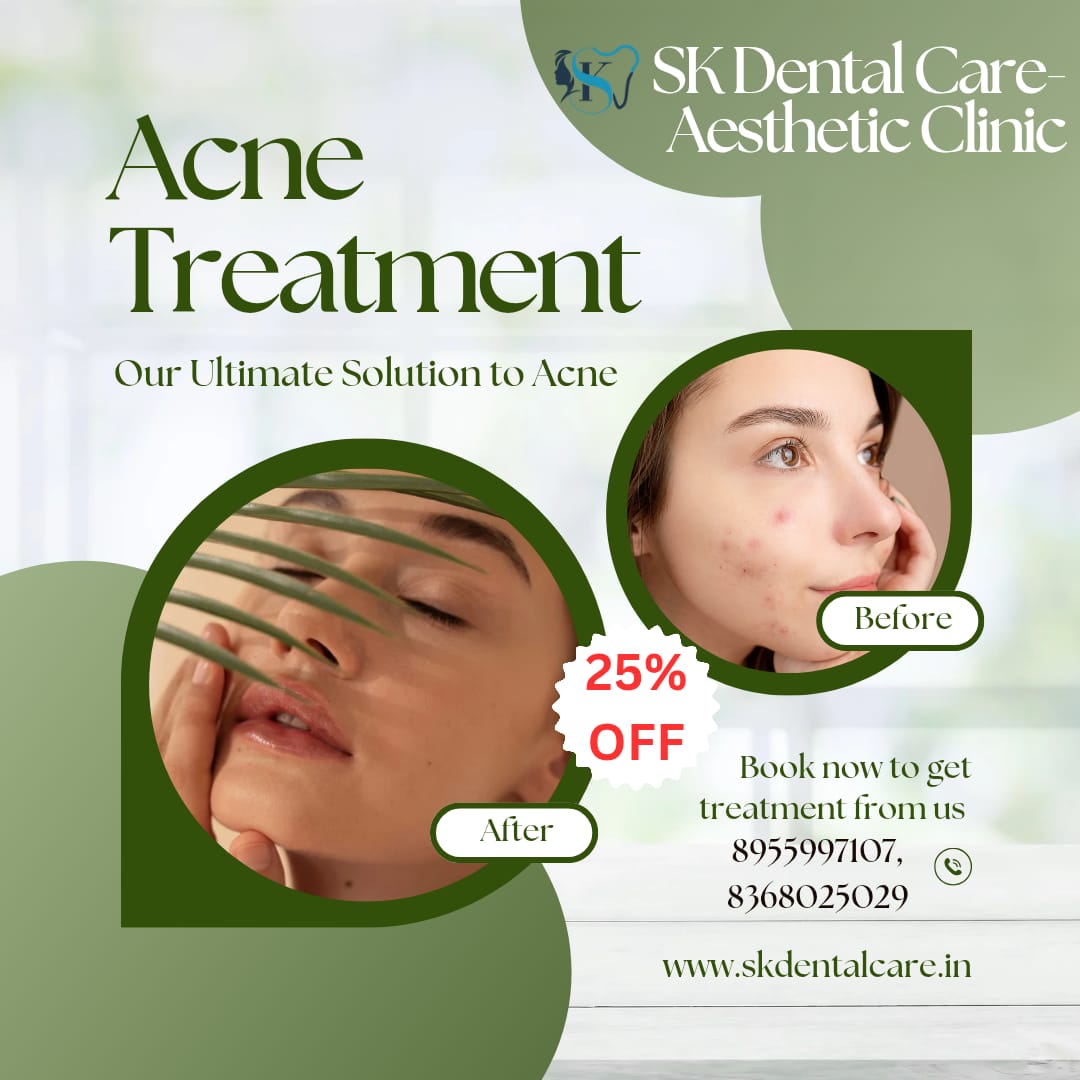 Acne Treatment